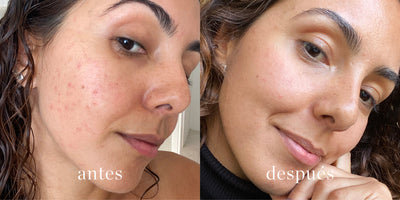 eliminar el acné con productos naturales del cuidado de la piel